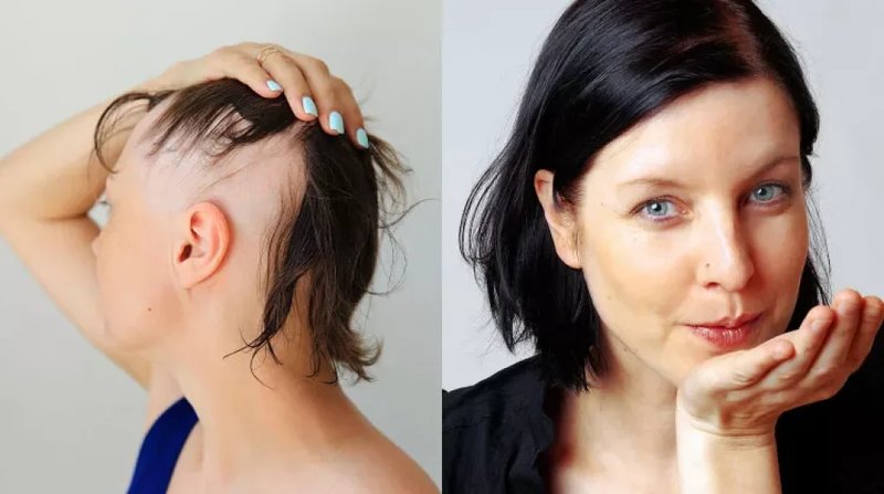 Image: Produkty Trichomist Forte - Rozwiązanie dla Problemów z Włosami